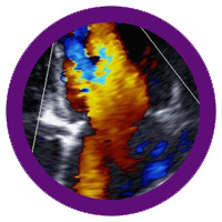 Echocardiogram-mmi