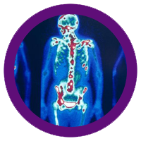nuclear-bone-scan
