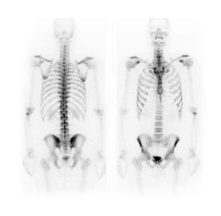 nuclear bone scan mmi
