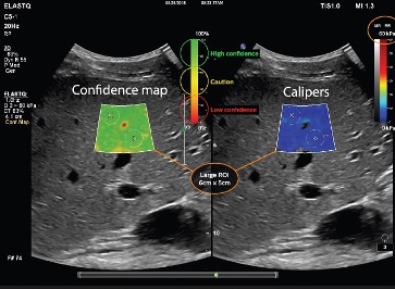 Elastography